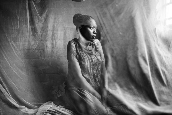 Nalumu / Acid attack survivor